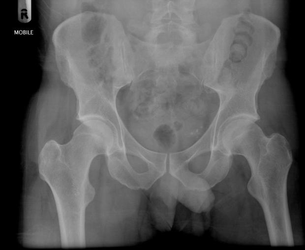 Normal pelvis of an adult Case courtesy of Dr Ian Bickle, Radiopaedia.org, rID: 37956